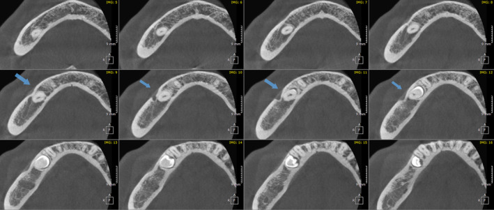 CBCT 축상면에서 이공의 전방 연장 확인