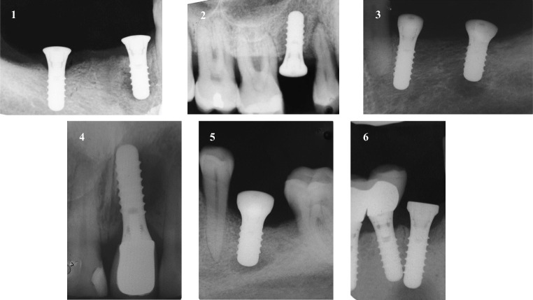 통증&middot;부종&middot;누공 등이 나타난 역행성 임플란트 주위염 6례의 방사선 사진. Di Murro et al., 2021, Figure 2, CC BY.