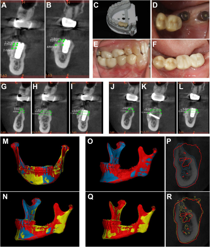 논문에 실린 증례 이미지 2/2 · Figure 4 · 임플란트 심고 4개월 뒤 3D 영상과 보철, 이식 전·7개월 뒤·식립 4개월 뒤의 폭 변