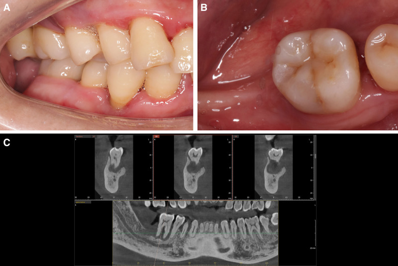논문에 보고된 증례 이미지 1/2 · Figure 1 · 오른쪽 아래턱 46번 부위의 협측·교합면과 수술 전 CBCT 평가를 함께 보여줍니다. 