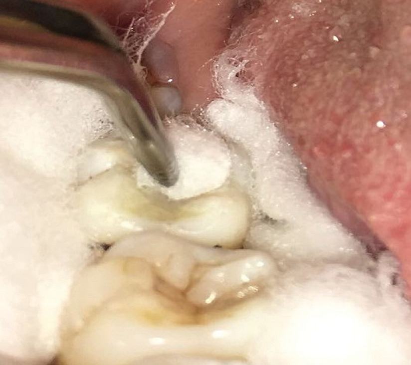 추가 논문 3 표제면 — Journal of International Society of Preventive & Community Dentistry