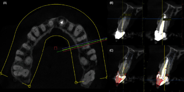 앞니 파절 부위 CBCT 단면 및 가상 식립 계획
