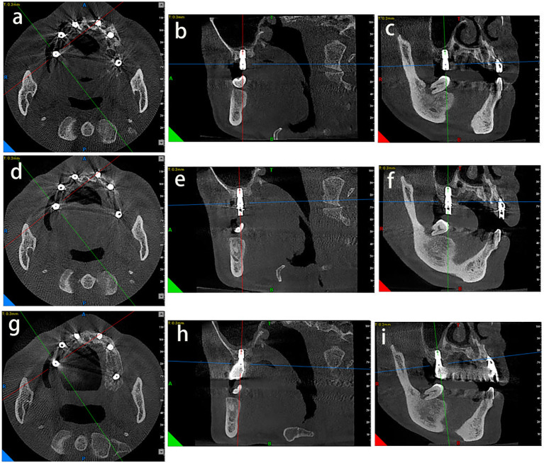 CBCT 측정 화면