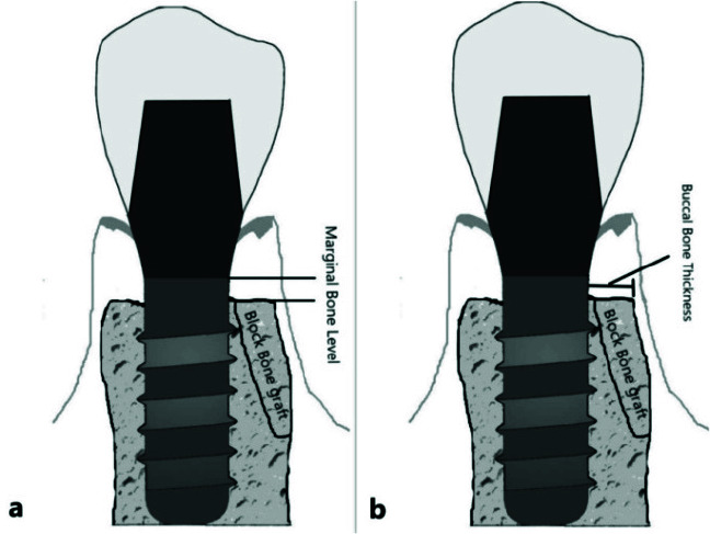 논문에 실린 증례 이미지 2/2 · Figure 3 · 3D 영상에서 임플란트 주변 뼈 높이(MBL)와 바깥쪽 뼈 두께(BBT)를 잰 방법을 a