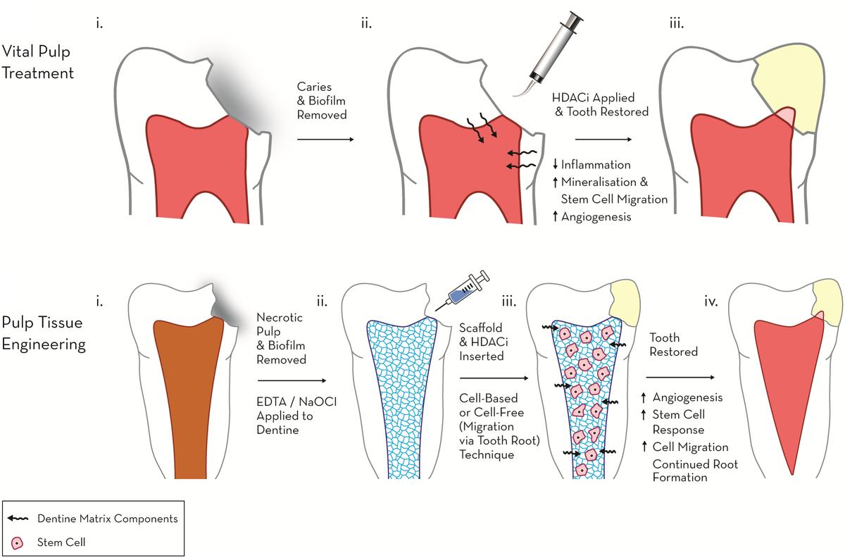 추가 논문 2 표제면 — International Endodontic Journal