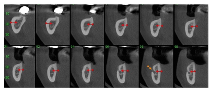 논문에 보고된 증례 이미지 1/2 · Figure 2 · 신경 이동술 계획에 사용한 오른쪽 아래턱 CBCT 단면을 보여줍니다. 출처: (PMC4