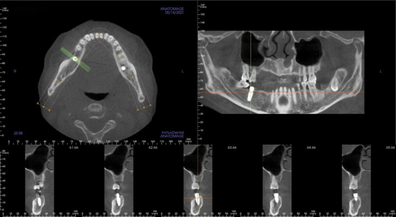 논문에 보고된 증례 이미지 2/2 · Fig. 3 · 동적 내비게이션으로 즉시 식립한 아래턱 구치부의 수술 후 CBCT 단면을 보여줍니다. 출처
