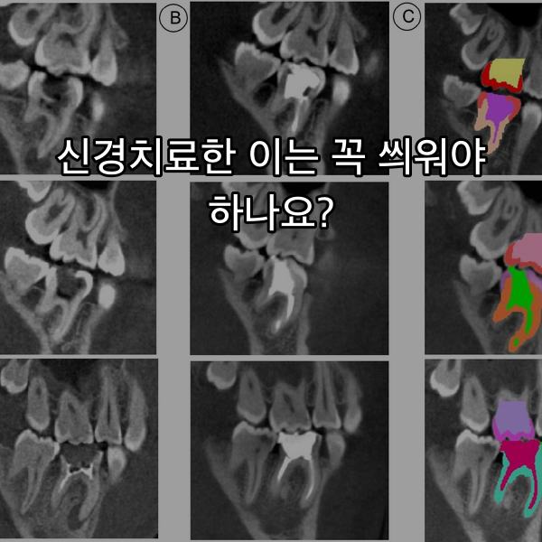 연세굿플란트치과 칼럼 썸네일 이미지