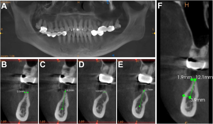 논문에 실린 증례 이미지 1/2 · Figure 1 · 수술 전 3D(CBCT) 파노라마에서 36·37번 자리의 쓸 수 있는 뼈 높이와 잇몸뼈 