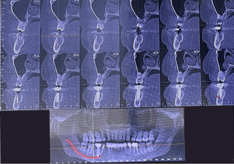 논문에 보고된 증례 이미지 2/2 · Figure 3 · CBCT 단면에서 임플란트 끝이 하치조신경관에 닿아 있는 3차원 위치 관계를 보여줍니다