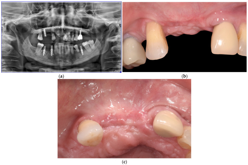 논문에 실린 증례 이미지 2/2 · Figure 6 · 수술 후 파노라마와 1개월 뒤 잇몸이 아문 상태의 정면·씹는 면 모습을 보여줘요. 출처: