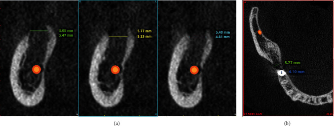 논문에 보고된 증례 이미지 2/2 · Figure 4 · CBCT 수직·축상 단면에서 식립공이 사용 임플란트 직경보다 크게 형성됐고 하방 경계가