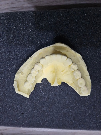 송파구치과 연세굿플란트치과 잠실송파본점 사례: 3D CT 및 구강 스캔 모의수술 분석 2
