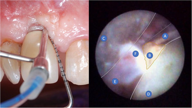 임플란트 보철 주변을 내시경으로 관찰해 잔여 시멘트를 확인하는 모습. Montevecchi et al., 2025, Figure 2, CC BY.