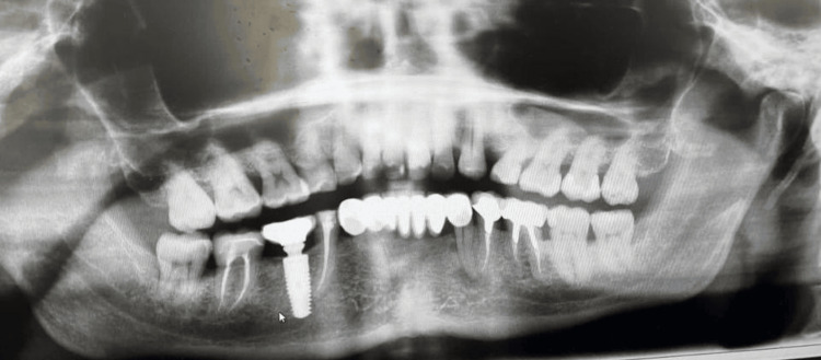 논문에 보고된 증례 이미지 1/2 · Figure 2 · 파노라마에서 46번 임플란트 끝이 하치조신경관에 닿아 있는 위치 관계를 보여줍니다. 출