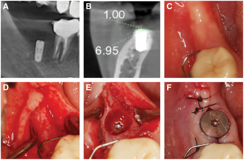 수술 6개월 뒤 CBCT 측정 및 치유 지대주 연결