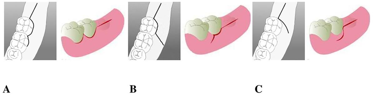 The influence of flap design on patients' experiencing pain 논문 표제면
