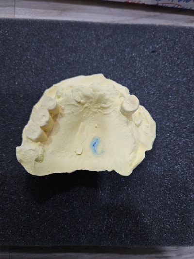 송파구치과 연세굿플란트치과 잠실송파본점 사례: 3D CT 및 구강 스캔 모의수술 분석 1