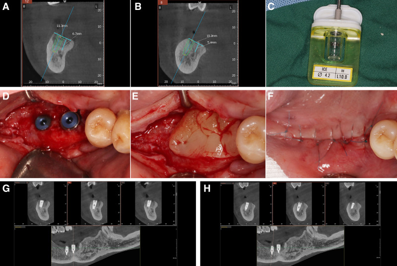 논문에 보고된 증례 이미지 2/2 · Figure 3 · 46·47번 부위의 CBCT 가상 식립, 수술 과정과 식립 후 CBCT 위치 확인을 한